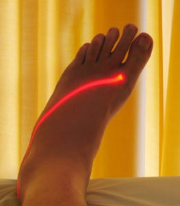 Terapia laserowa stopy